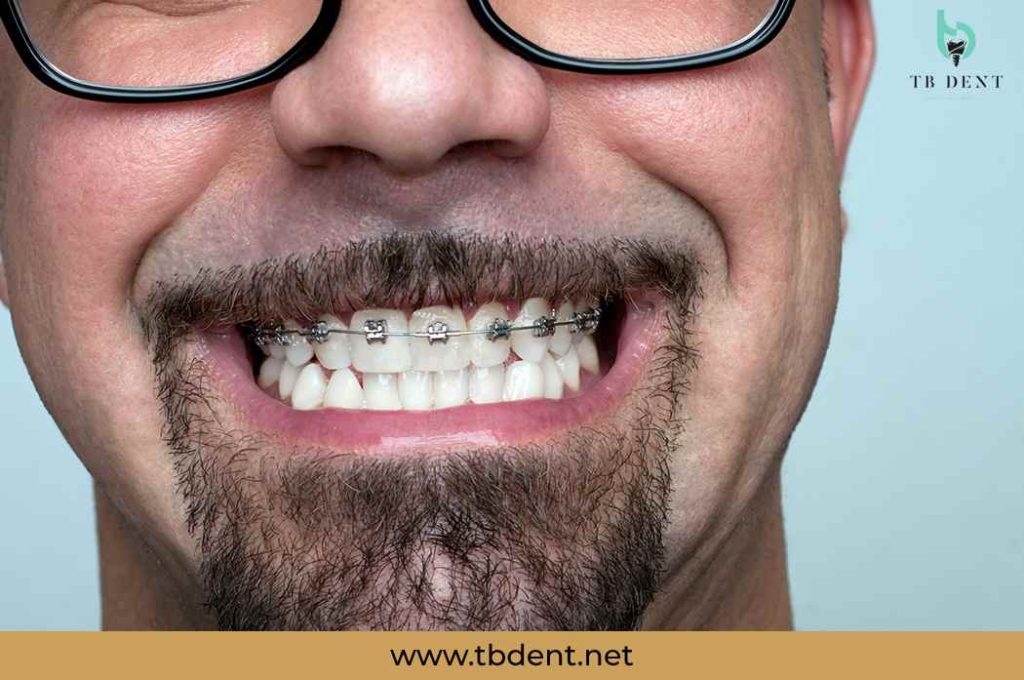 ortodoncija za odrasle