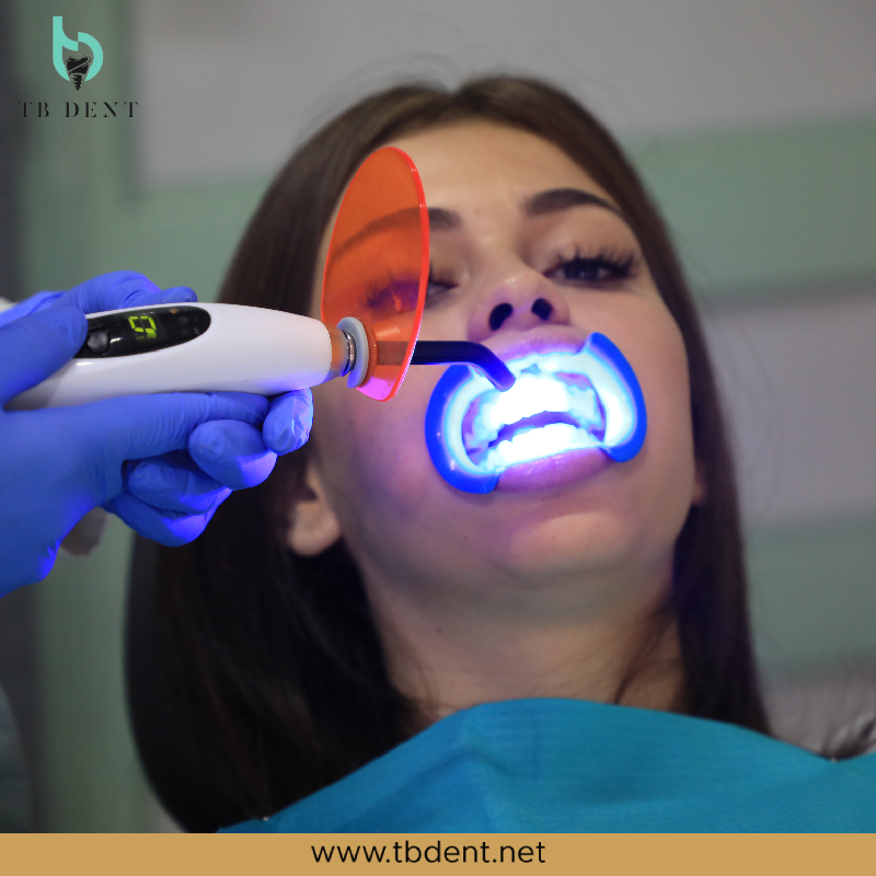 lasersko izbjeljivanje zuba