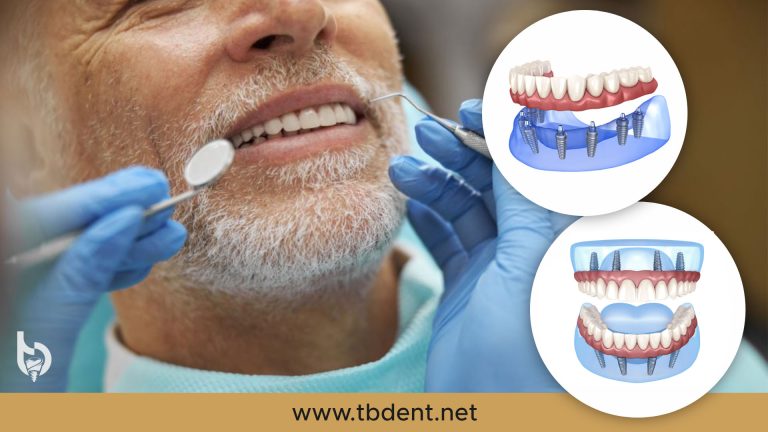 tb dent all on 4 6 trebinje 768x432 1