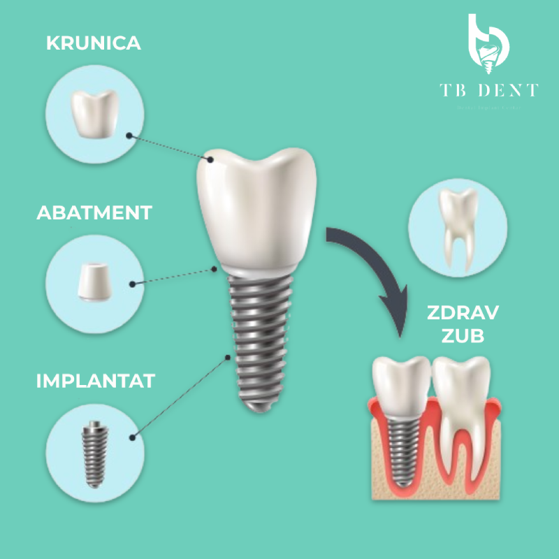 Sve što vas zanima o implantatima 4 zubni implantati proces trebinje